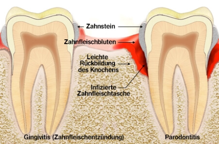 Von der Zahnfleischentzündung (Gingivitis) zur Parodontose (Parodontitis)